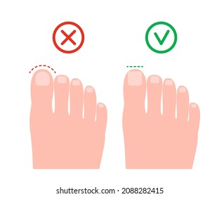 Cut nail on leg wrong and right, health pedicure. Circle and straight cutting nail. Prevention of ingrown nails. Vector illustration