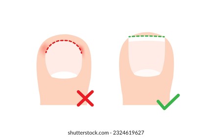 Cut toenail right and wrong concept, ingrowing toenail prevention. Circle and straith nail cutting