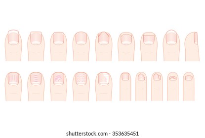 Cut the toenails. Condition of the nails of the foot.