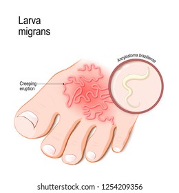 Cutaneous larva migrans. Skin disease in humans caused byhookworm (Ancylostoma braziliense). Vector illustration for medical, biological, science and educational use