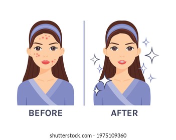 Cute brunette woman with pimples on her face. Acne Treatment. Before after. Problematic and clear skin. Healthy happy lady. Flat cartoon color style. White background. Vector stock illustration.