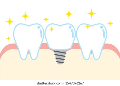 cute cartoon illustration implant tooth