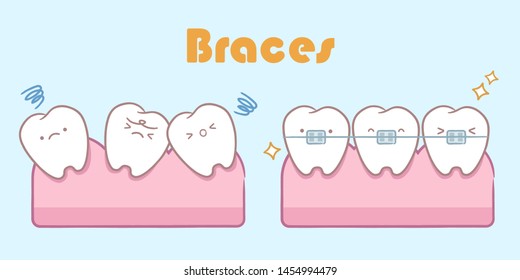 cute cartoon tooth with brace correction concept on blue background