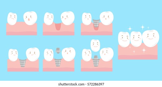 cute cartoon tooth implant smile happily with gum