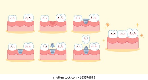 cute cartoon tooth implant smile happily with gum