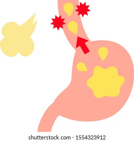 Cute illustration of reflux esophagitis
