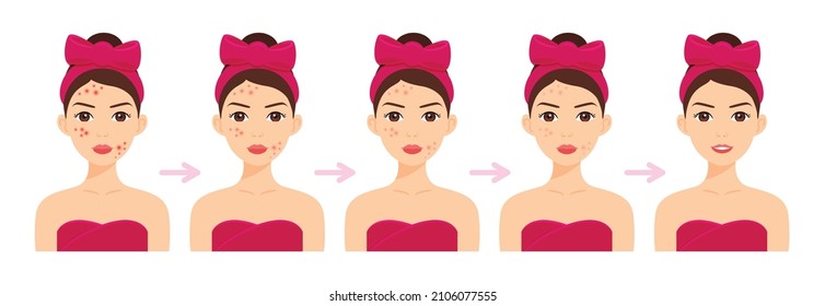 Weibe mit Pimples auf Gesicht. Akne Behandlung. Schritte. Facial Skin Whitening. Stufen. Fröhliches Mädchen mit einem Lächeln und sauberer Haut. Cartoon-Stil. Weißer Hintergrund. Vektorgrafik für Beauty Design.