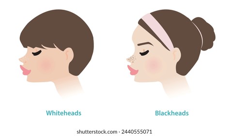 Cute women with whiteheads and blackheads acne on noses vector illustration. Whiteheads and blackheads are both types of non inflammatory acne, they are forms of comedones. The pore is closed or open.