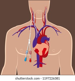 CVC central venous catheter - dialysis acces - full color diagram - vector illustration