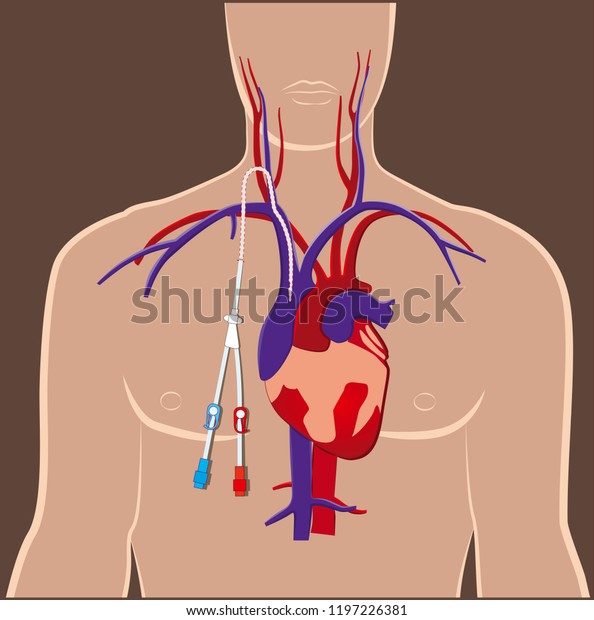 CVC central venous catheter -\
dialysis acces - full color diagram - vector\
illustration