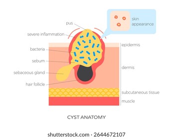 Ilustração do vetor plano da anatomia do cisto. Infográfico médico mostrando a estrutura da pele, acúmulo de sebo, inflamação e visão superficial. Cuidados com a pele e conceito dermatológico.