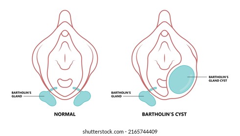 ฺฺBartholin’s cyst vagina pain lump  mass E. coli sex safe pelvic exam cervix swollen pus lips vulva blockage