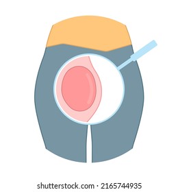 ฺฺBartholin’s cyst vagina pain lump  mass E. coli sex safe pelvic exam cervix swollen pus lips vulva blockage