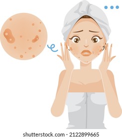 cystic acne female face skin. girl wrapped in towel