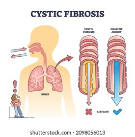 Cystic fibrosis disorder or healthy airflow airway comparison outline diagram. Labeled educational medical disease explanation with anatomical human pulmonary organ differences vector illustration.
