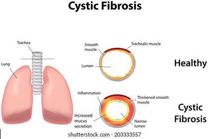 Cystic Fibrosis Labeled Diagram