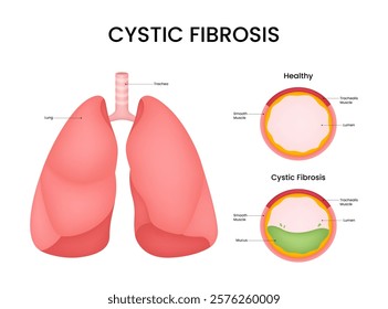 Cystic Fibrosis Symptoms and Causes