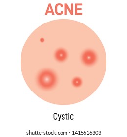 Cystic skin acne type vector icon. Skin disease acne whiteheads pimples type and face pore comedones. Type of acne  illustration vector on white background. 