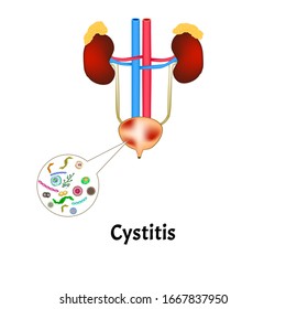 Cistitis. Inflamación de la vejiga. La estructura de los riñones y la vejiga. infografías de sistemas excretivos. Ilustración vectorial en fondo aislado.