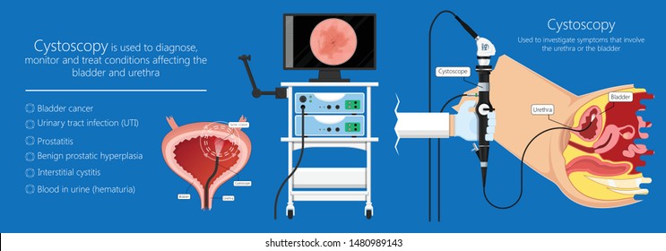 290 Cystoscopy Images, Stock Photos & Vectors | Shutterstock