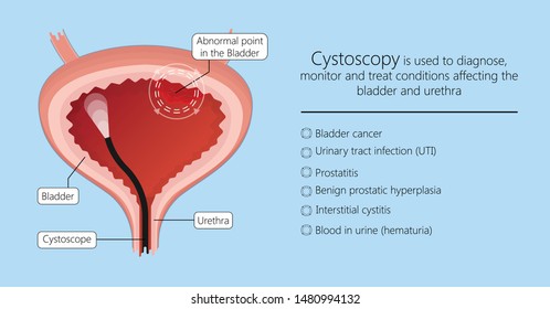 Cystoscopy Images Stock Photos Vectors Shutterstock