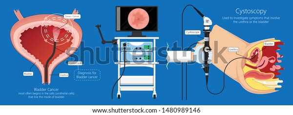 Cystoscopy Diagnose Bladder Diseases Conditions Exam Stock Vector Royalty Free 1480989146 3514