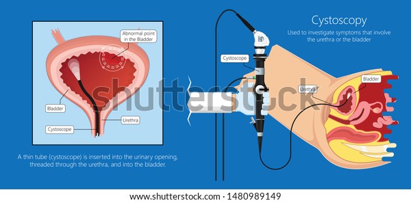 Cystoscopy Diagnose Bladder Diseases Conditions Exam Stock Vector ...