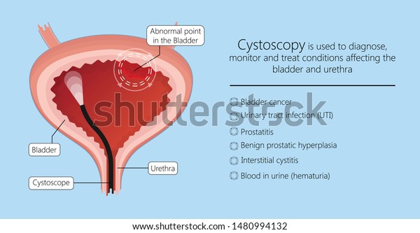 prostatite cistoscopica prostatite cistoscopica