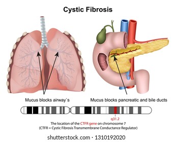 Cystric fibrosis 3d medical vector illustration with description