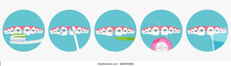 Daily Oral Hygiene, Teeth With Braces, Vector Illustration.