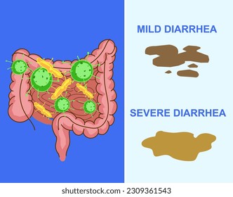 Dairea. Stool chart. Bacteria in the gut. Health problems. Medical illustration. Vector illustration.
