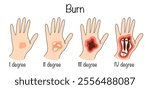 Damage to body tissue caused by high temperatures. Drawings of the degree of damage to the skin and tissue of a person’s hand, depending on the intensity of the damage. Color vector illustration.