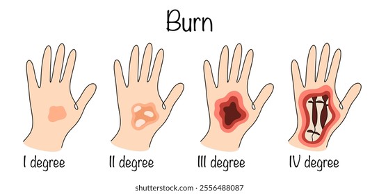 Damage to body tissue caused by high temperatures. Drawings of the degree of damage to the skin and tissue of a person’s hand, depending on the intensity of the damage. Color vector illustration.