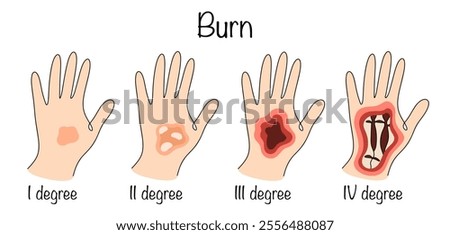 Damage to body tissue caused by high temperatures. Drawings of the degree of damage to the skin and tissue of a person’s hand, depending on the intensity of the damage. Color vector illustration.