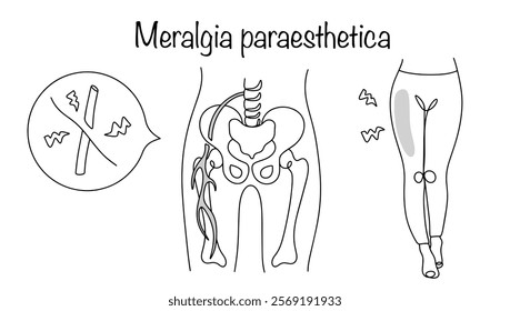 Damage to the external cutaneous nerve of the thigh, which manifests itself as pain and loss of sensitivity on the surface of the thigh. A hand-drawn diagram of a disease for use in the medical field.