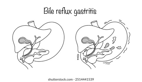 Damage to the gastric mucosa caused by retrograde reflux of duodenal contents into the stomach. Hand drawn gastrointestinal disease. Vector illustration.