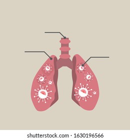 Damage Lung Infection By Coronavirus