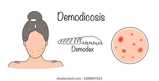 Damage to the skin and hair caused by microscopic mites. A woman with a rash on her face caused by a parasite. Vector illustration on the theme of dermatology and cosmetology.