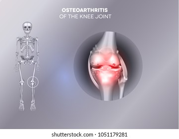 Damaged joint on a grey background.