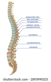 Damaged spine. Infographics of various back diseases. Vector illustration