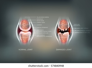 Damaged Synovial joint and normal joint colorful design on an abstract grey background.