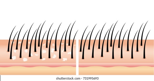 Dandruff on hair before and after (vector),hair scalp. Treatment of dandruff on the scalp. compare normal and abnormal hair on the scalp for advertisement ,poster, beauty clinic , cosmetic and banner.