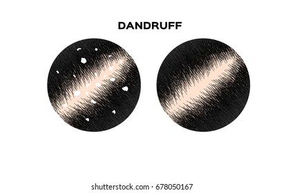 Dandruff on hair vector , closeup on skin