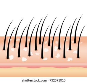 Dandruff on hair (vector),hair scalp. Fungus on the scalp.Cause of hair loss. Allergic to toxins. Disorders of the scalp.