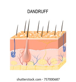 Dandruff. seborrheic dermatitis can occur due to dry skin, bacteria and fungus on the scalp. It causes formation of dry skin flakes on the scalp. Layers of the human skin