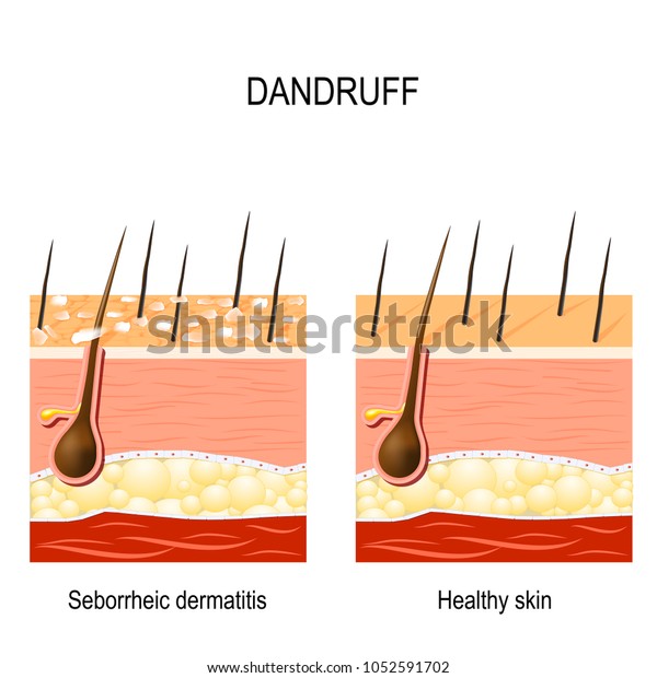 ふけ 脂漏性皮膚炎は 皮膚の乾燥 細菌 頭皮の真菌が原因で起こる可能性がある 皮膚の乾いた剥片の形成を引き起こす 皮膚の正常な毛髪と異常な毛髪を比較する のベクター画像素材 ロイヤリティフリー