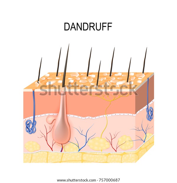 Dandruff. seborrheic\
dermatitis can occur due to dry skin, bacteria and fungus on the\
scalp. It causes formation of dry skin flakes on the scalp. Layers\
of the human skin