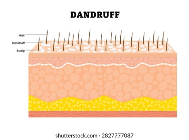 Dandruff. Seborrheic dermatitis on dry skin. Bacteria and fungus on formation the flakes scalp. Dermatitis. Human skin layers anatomy cross section. Vector illustration