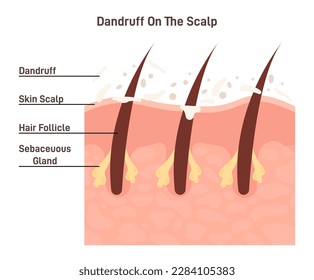 Dandruff. Skin flakes on itchy and dry scalp. Cross section of skin on the scalp and hair follicles. Common hair problem and dermatology disorder. Flat vector illustration