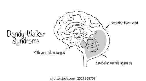 Síndrome De Dandy-Walker. Malformação cerebral, manifestada por violação da estrutura do cerebelo, expansão do quarto ventrículo e cisto na região occipital. Vetor médico.